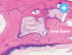 Image of human histology 4-6 months post-op - OSSIX PLUS®, new bone & OSSIX PLUS®