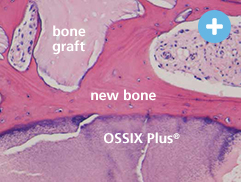 Image of human histology 4-6 months post-op - bone graft, new bone & OSSIX PLUS®