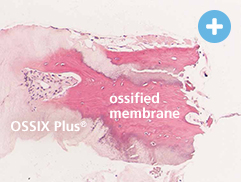 Image of human histology 4-6 months post-op - OSSIX PLUS® & ossified membrane