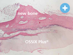 Image of human histology 4-6 months post-op - new bone & OSSIX PLUS®