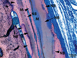 Image of OSSIX™ Volumax that shows mineralization progressing in to ossification at 6 months