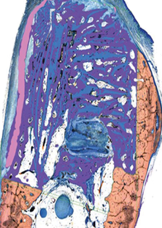 Image of OSSIX™ Bone + OSSIX PLUS® at 6 months
