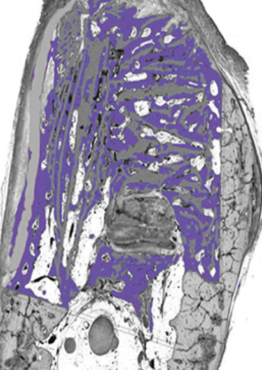 Image of OSSIX™ Bone + OSSIX PLUS® at 6 months