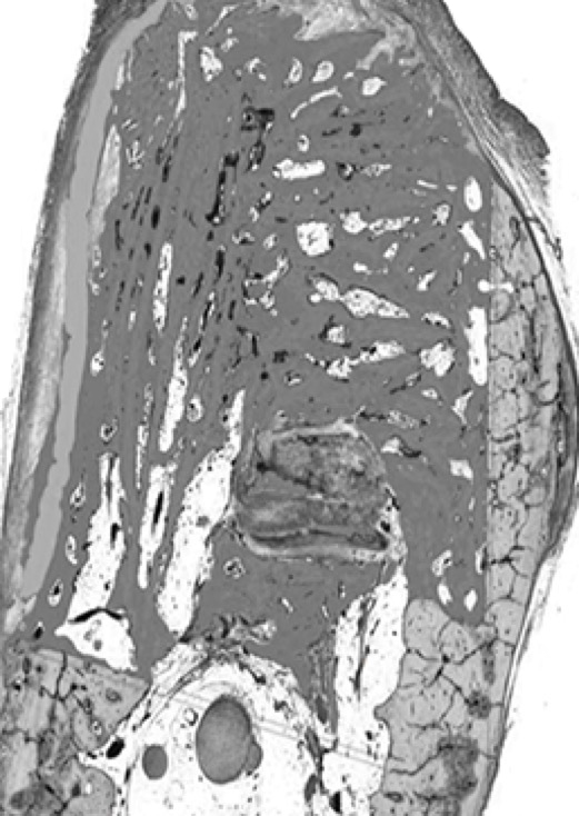 Image of OSSIX™ Bone + OSSIX PLUS® at 6 months