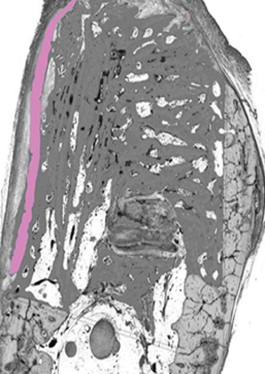 Image of OSSIX™ Bone + OSSIX PLUS® at 6 months