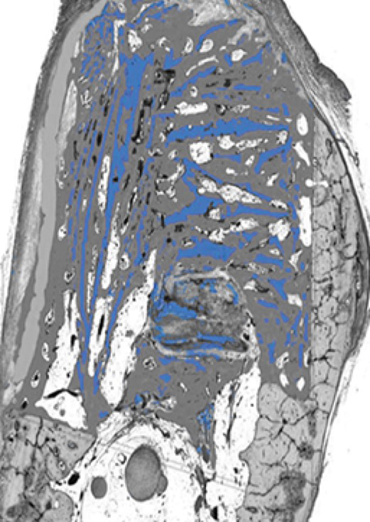 Image of OSSIX™ Bone + OSSIX PLUS® at 6 months