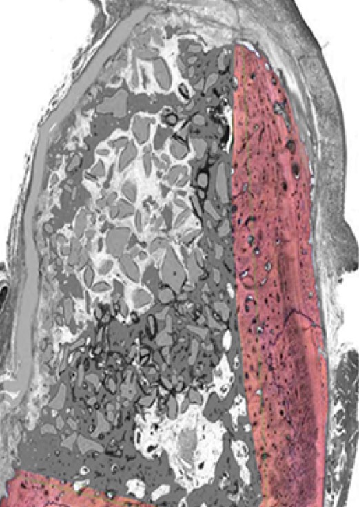 Image of Bio-Oss® Collagen + OSSIX PLUS® at 6 months