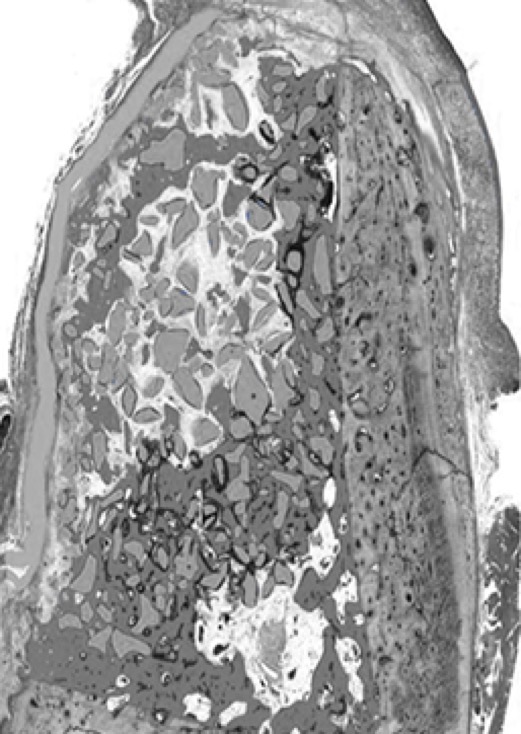 Image of Bio-Oss® Collagen + OSSIX PLUS® at 6 months